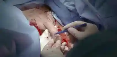 血腥重口 慎入 罕见的医院内部变性手术视频流出 全程皱眉看完 太痛了